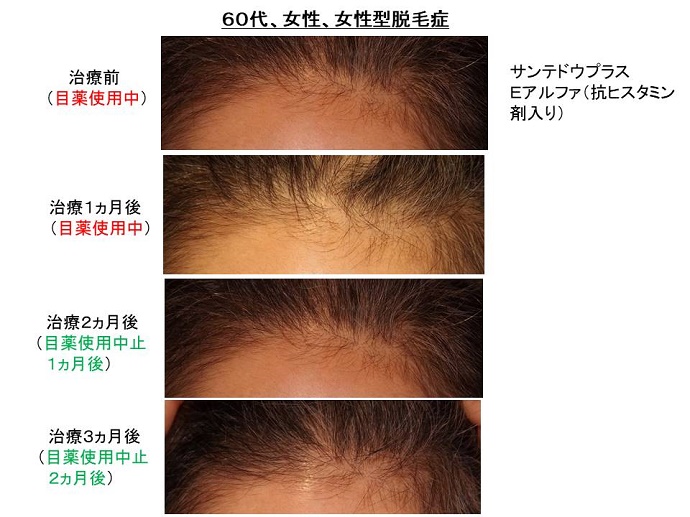 円形脱毛症　病院""